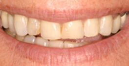 Rochelle closeup before dental treatment actual patient