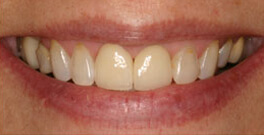 Closeup after dental treatment actual dental patient