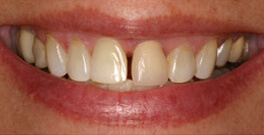 Closeup before dental treatment actual dental patient