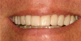 Stan closeup after dental treatment actual patient