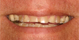 Stan closeup before dental treatment actual patient