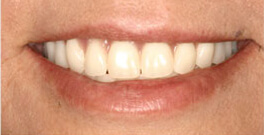 J H closeup after dental treatment actual patient