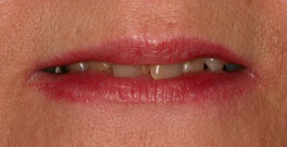 Actual dental patient closeup before dental treatment