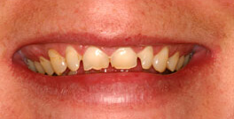 J B closeup before dental treatment actual patient