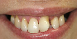 I B closeup before dental treatment actual patient