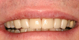 P C closeup after dental treatment actual patient