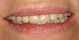 L C closeup after dental treatment actual patient