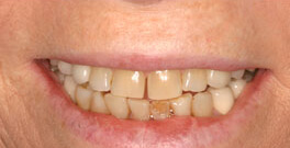 L C closeup before dental treatment actual patient