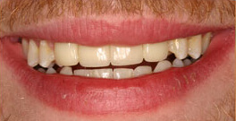 K D closeup after dental treatment actual patient