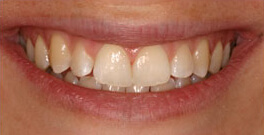 L H closeup after dental treatment actual patient