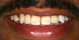 M B closeup after dental treatment actual patient