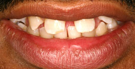 M B closeup before dental treatment actual patient