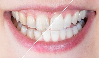 Up-close view of stained and brighter teeth