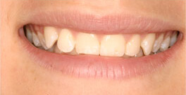 Anna closeup before dental treatment actual patient