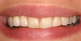 Ieva closeup before dental treatment actual patient
