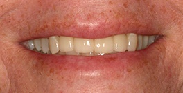 M B closeup after dental treatment actual patient