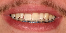 J L closeup before dental treatment actual patient