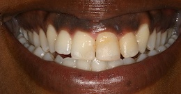 K E closeup after dental treatment actual patient