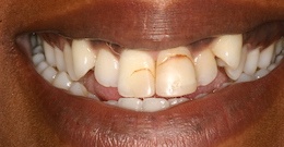 K E closeup before dental treatment actual patient