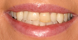 closeup before dental treatment actual patient