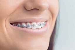 Closeup of smile with traditional braces