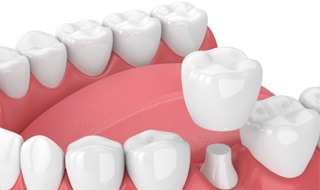 a digital illustration of a dental crown