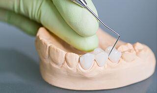dental bridge tooth model