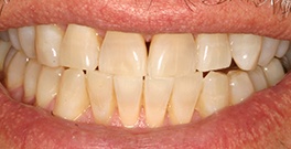 L T closeup after dental treatment actual patient
