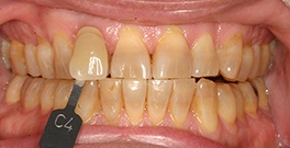 L T closeup before dental treatment actual patient
