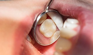 a dental mirror showing a tooth with a cavity filling