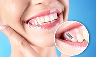 Nose-to-neck view of woman smiling with one tooth indicated as implant
