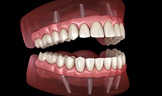 Illustration of fixed implant dentures