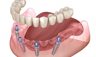 Illustration of removable implant dentures