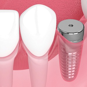 Digital illustration of a dental implant