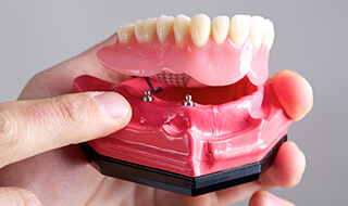 Dental implant retained denture model