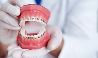 Closeup of braces on model of teeth