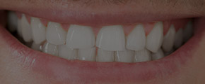 Closeup of healthy smile after restorative dentistry