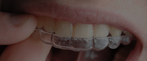 Closeup of dental patient placing an Invisalign orthodontics tray