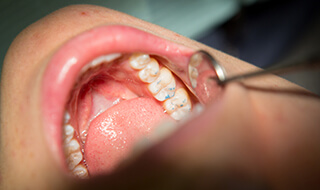 Dentist checking smile with dental mirror after tooth colored fillings