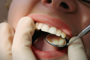 Patient gets an oral cancer screening from their Marlton dentist