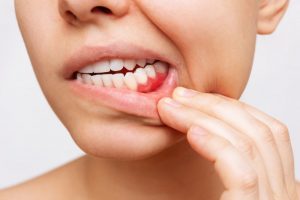 a woman revealing her inflamed gums